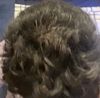 22M Considering Minoxidil/Finasteride for Crown Thinning, Seeking Dosage Advice
