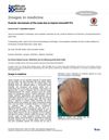 Pustular Dermatosis of the Scalp Due to Topical Minoxidil 5%