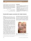 Pyodermatitis Vegetans Associated with Multiple Myeloma
