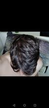 1year 1.25mg fin a day