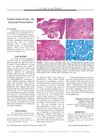Eccrine Duct Dilation as a Marker of Cicatricial Alopecia