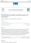 Dermoscopy of Annular Elastolytic Giant Cell Granuloma