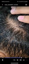 20M Experiencing Heavy Hairfall Please Helpppp