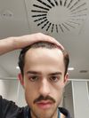 Should I start taking finasteride?