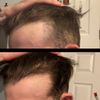 Getting worse? Taking fin from Ro and switching to Amazon pharmacy seeing so much more hair fall is it just shedding? Or do I need to add more to my regiment? Change stuff up entirely?