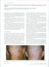 Phototherapy as a Useful Therapeutic Option in the Treatment of Diphenylcyclopropenone-Induced Vitiligo