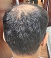 24M, 1 Year on Fin+Min with Stabilized Loss, Seeking Advice on Next Steps