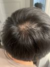 What do I do now? I’m new here. Hair crown looks thinning. 26m
