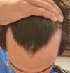 23M Concerned About Hair Loss After Stopping Finasteride