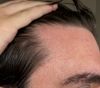 21m- should i wait until next year to get on oral min like my doctor wants, or go a different path?