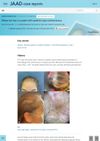Diffuse Hair Loss in a Patient With Systemic Lupus Erythematosus