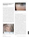 Discoid Lupus Alopecia Complicated by Frontal Fibrosing Alopecia on a Background of Androgenetic Alopecia
