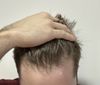 Can I save my hair without a hair transplant?