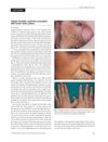 Alopecia Triangularis Congenita in Combination with Androgenetic Alopecia