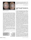 Granulomatous Pigmented Purpuric Dermatosis Containing Propionibacterium Acnes