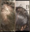 6 Months on Minoxidil: Bald Spots Still Visible, Seeking Advice Before Dermatologist Visit