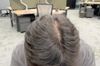 18M Noticing Top Scalp Thinning - Should I Start Min/Fin?