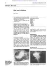 Hair Loss in Children