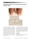Pohl-Pinkus Constrictions of Hair Following Chemotherapy for Hodgkin's Disease