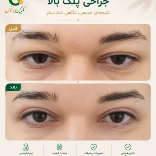 ✨ وقتی چشم‌ها جوان‌تر می‌شوند، تمام چهره تغییر می‌کند...

افتادگی پلک می‌تواند باعث خسته، غمگین یا ح