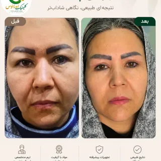 👁️ وقتی خستگی از نگاه حذف می‌شود...

افتادگی پلک می‌تواند چهره را خسته‌تر، غمگین‌تر و حتی مسن‌تر از