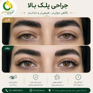 ✨ گاهی فقط چند میلی‌متر تغییر، می‌تواند سال‌ها جوان‌ترتان کند...

افتادگی پلک بالا فقط یک مسئله زیبا