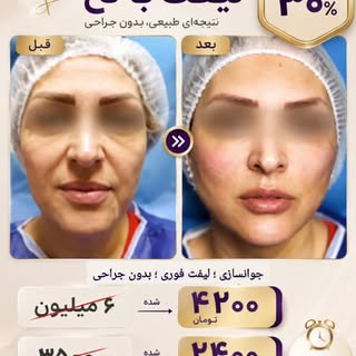 ✨ بدون جراحی، جوان‌تر دیده شوید...
اگر افتادگی خفیف تا متوسط پوست صورت شما را آزار می‌دهد، لیفت با ن