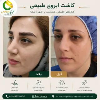 🌿 کاشت ابرو؛ بازگشت زیبایی طبیعی به چهره شما

ابروها نقش مهمی در زیبایی و جذابیت صورت دارند. اگر به