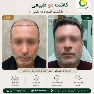 ✨ اعتمادبه‌نفس از خط رویش مو شروع می‌شود...
کم‌پشت شدن موها فقط یک تغییر ظاهری نیست؛ گاهی روی حس خوب