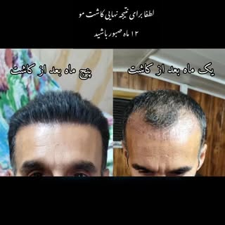 نمونه کاشت مو کلینیک تخصصی کاشت مو رازی 

📞جهت مشاوره رایگان

09015897691

کلینیک#کلینیک رازی#کلینی