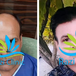 نمونه کاشت مو کلینیک تخصصی کاشت مو رازی 

📞جهت مشاوره رایگان

09015897691

کلینیک#کلینیک رازی#کلینی