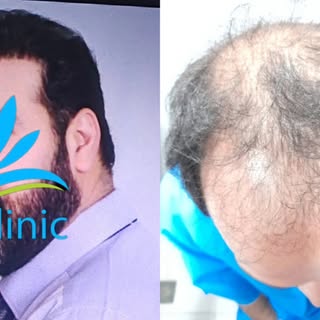 نمونه کاشت مو کلینیک تخصصی کاشت مو رازی 

📞جهت مشاوره رایگان

09015897691

کلینیک#کلینیک رازی#کلینی