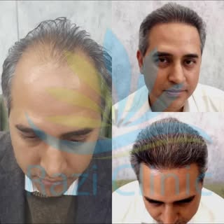 نمونه کاشت مو کلینیک تخصصی کاشت مو رازی 

📞جهت مشاوره رایگان

09015897691

کلینیک#کلینیک رازی#کلینی