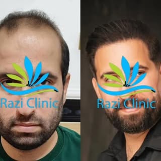 نمونه کاشت مو کلینیک تخصصی کاشت مو رازی

مشاوره رایگان 

📞 09015897691

کلینیک#کلینیک رازی#کلینیک ک