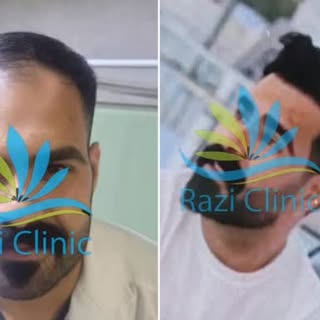 نمونه کاشت مو کلینیک تخصصی کاشت مو رازی 

📞جهت مشاوره رایگان

09015897691

کلینیک#کلینیک رازی#کلینی