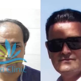 نمونه کاشت مو کلینیک تخصصی کاشت مو رازی 

📞جهت مشاوره رایگان

09015897691

کلینیک#کلینیک رازی#کلینی