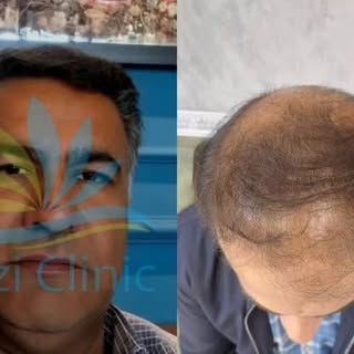 نمونه کاشت مو کلینیک تخصصی کاشت مو رازی 

📞جهت مشاوره رایگان

09015897691

کلینیک#کلینیک رازی#کلینی