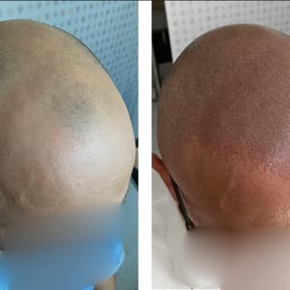💥efekt naturalnej mikropigmentacji skóry głowy po 3️⃣ sesjach #scalpmicropigmentation 

Sesję odbyw