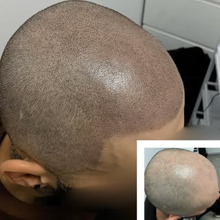 #smp #scalpmicropigmentation #mikropigmentacja to doskonała alternatywa dla #przeszczepwłosów 🧑🏼‍�