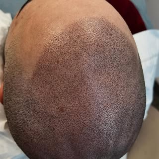 Hair loss can change the way you see yourself every single day.
This transformation was created to r