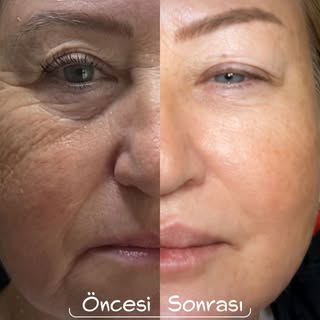 By now, you probably know what this procedure involves 😎 #liquidfacelift is one of the most popular