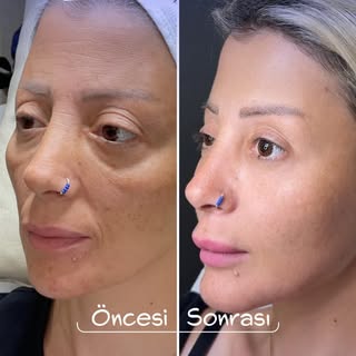 ✨ Full-Face Rejuvenation with Liquid Facelift

It is possible to soften the signs of aging on your f