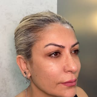 Aging is inevitable, but looking tired is not. The sagging and loss of tissue that occur in facial f