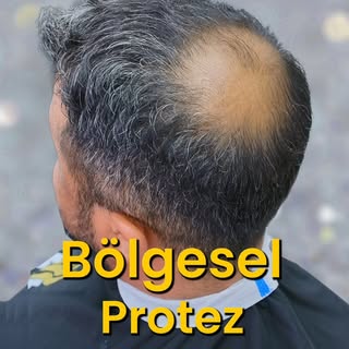 Bölgesel Protez Saç ile Doğal Dönüşüm! ✨👨‍🦱

Protez saç yaptırmak için tüm saçınızı kaybetmenize g