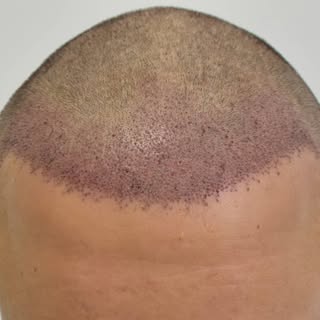 "What am I going to look like the next day after my hair transplant?" - patients often ask. 
Here is