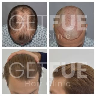 Another great result of Dr. Colak's work. Dr. Colak has a lot of experience with lighter hair types.
