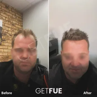 The results speak for themselves. The patient had 3700 grafts implanted into the hairline and fronta