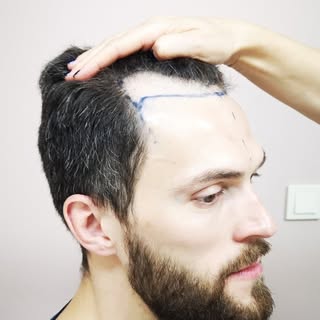 We would like to show a recent hairline recovery operation recently performed by Dr. Ayhan Colak. 
G