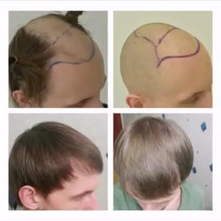 This is a 2500-graft operation plan and result. The hairline and frontal area density recovery has w