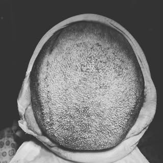 One of the largest crown recovery procedures - maximum density‼️. We are excited to see the results!
